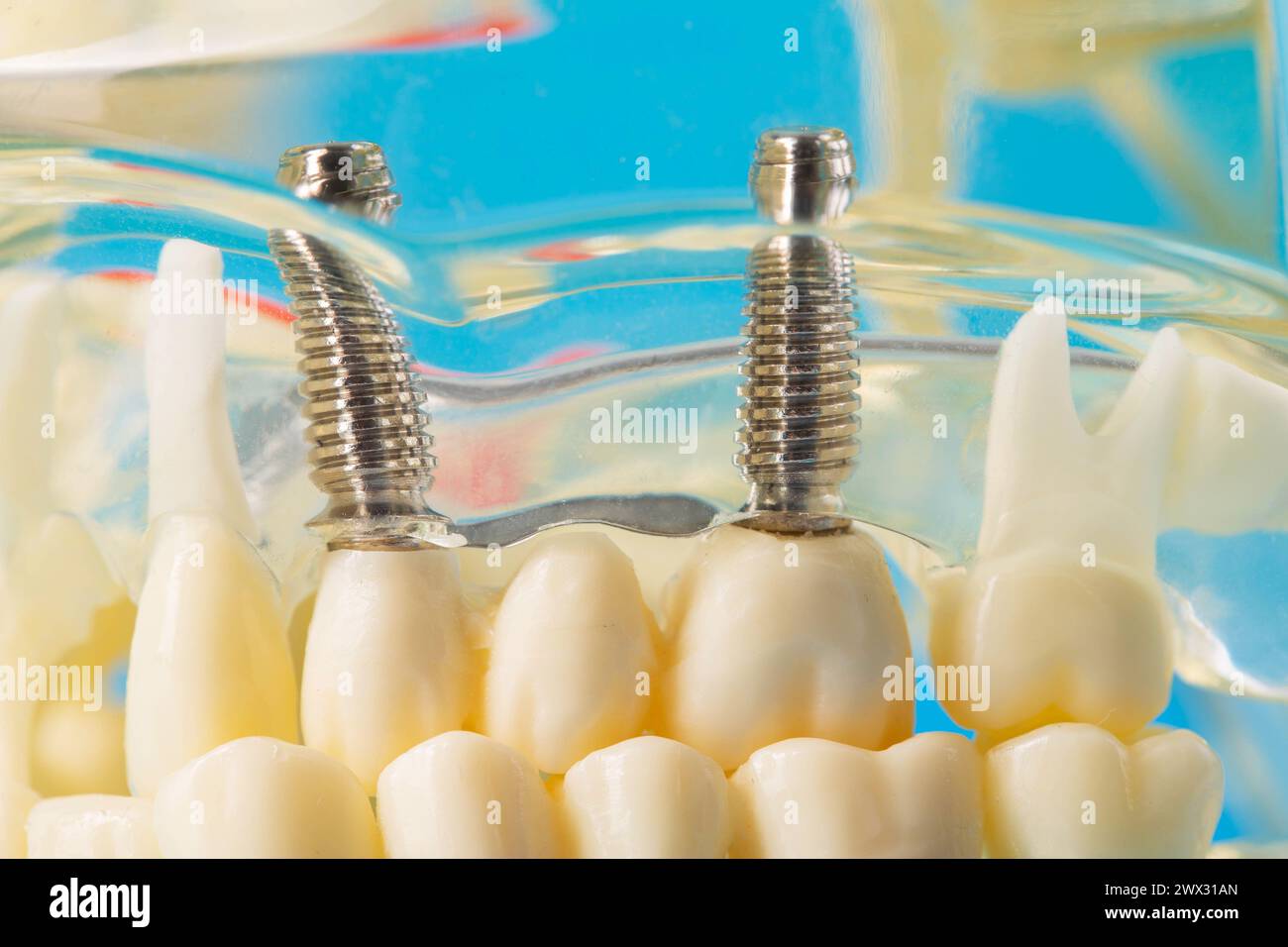 Medical model of a patient's dental jaw with pins in the gums and dental implants. Unerupted wisdom teeth, close-up. Restoration Stock Photo