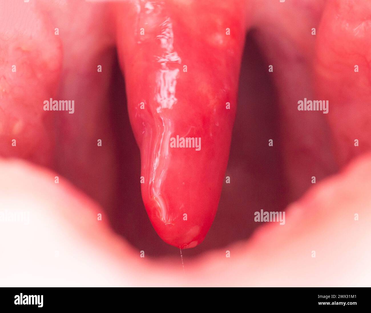 Long uvula with inflammation of infections and viruses. Treatment of uvulitis in children and adults. Sore throat, sore throat. Stock Photo