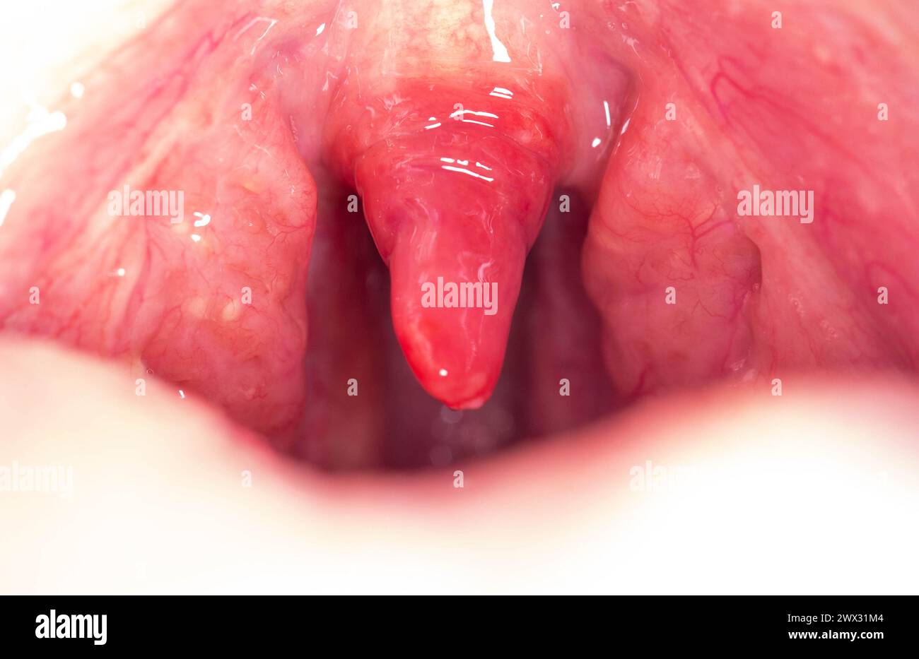 Long uvula with inflammation of infections and viruses. Treatment of uvulitis in children and adults. Sore throat, sore throat. Stock Photo