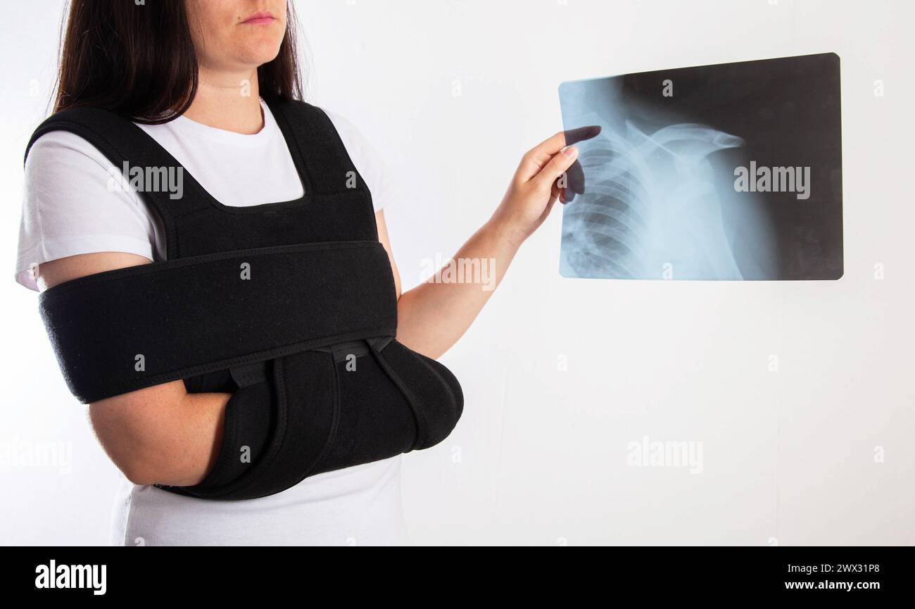 A girl holds an X-ray of a dislocation and fracture of the humerus in a bandage on the shoulder joint after a surgical operation. Stock Photo