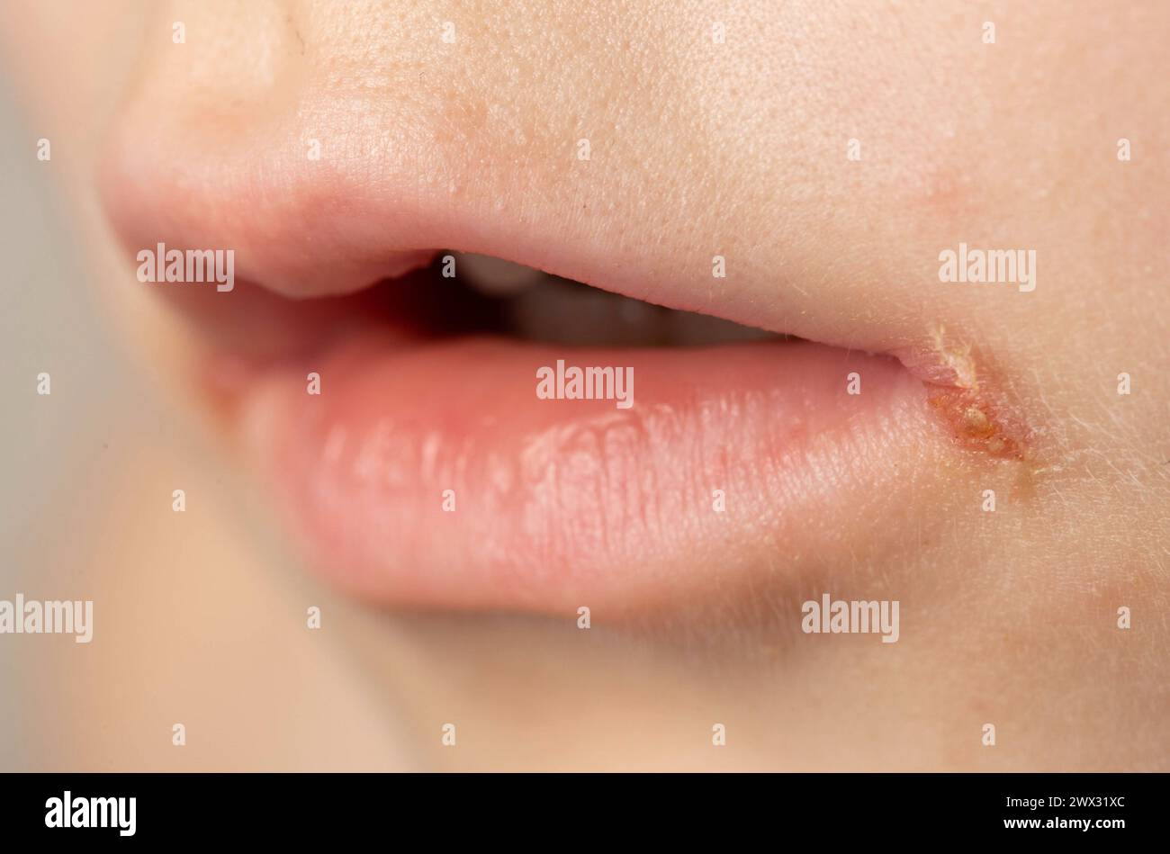 Seizures on the corners of the lips of a child s mouth. Bacterial ...