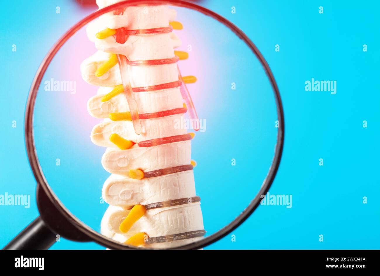 Model of the cervical spine with a compressed nerve root on a blue background under a magnifying glass. Concept of health and diseases of the spine. O Stock Photo