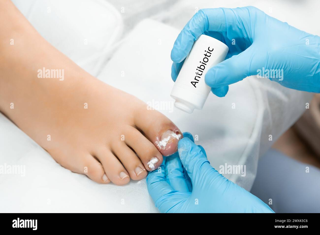 Podologist uses antibiotic after ingrown toenail removal Stock Photo