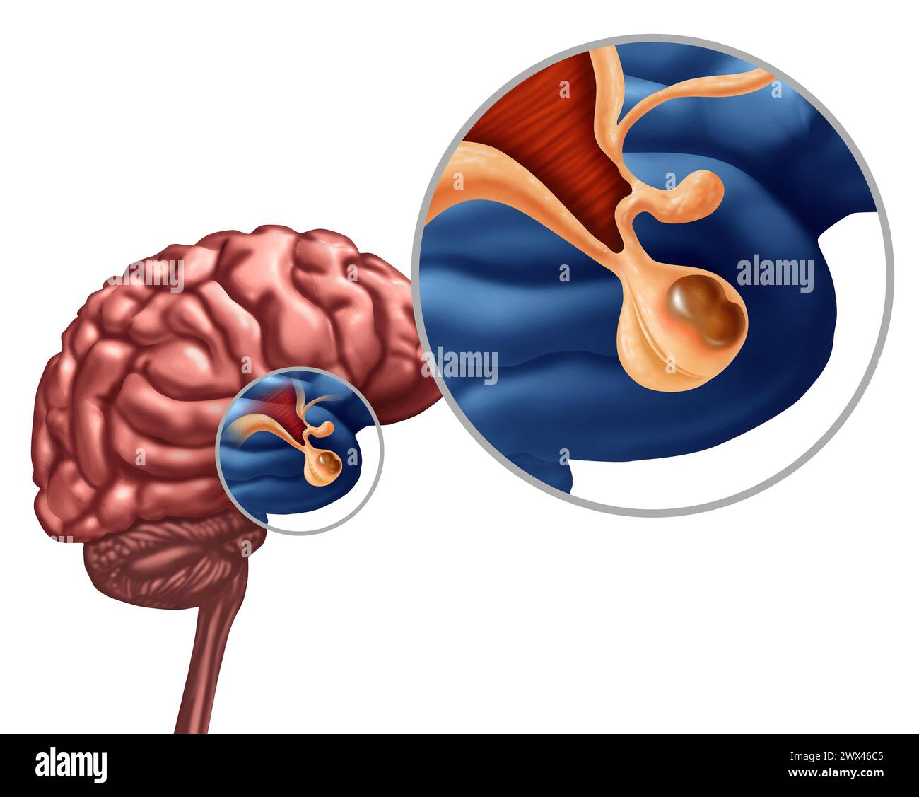 Pituitary Adenoma Benign Tumor as a noncancerous growth diagnosis on the Gland or Hypothalamus or hypophysis cerebri concept as part of the human anat Stock Photo