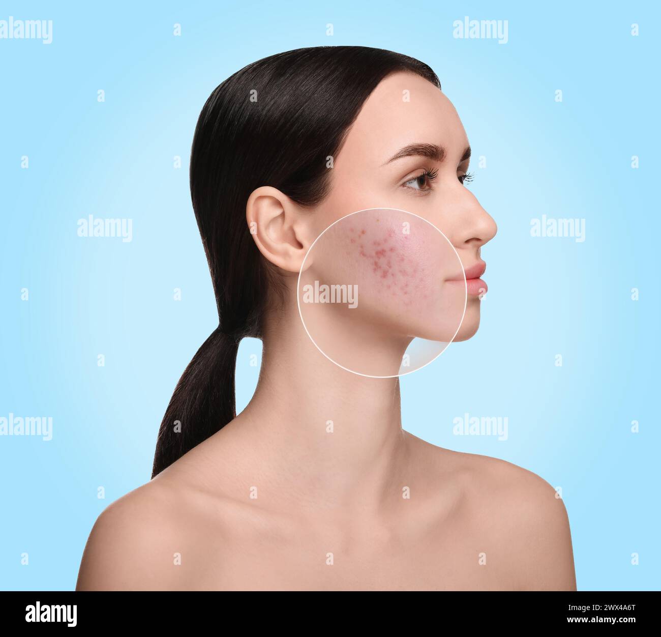 Woman with acne on her face on light blue background. Zoomed area ...