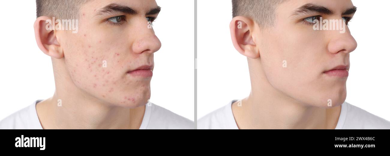 Acne problem. Young man before and after treatment on white background ...