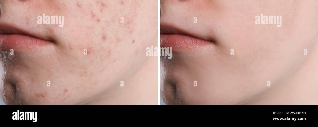 Acne problem. Young man before and after treatment, closeup. Collage of ...