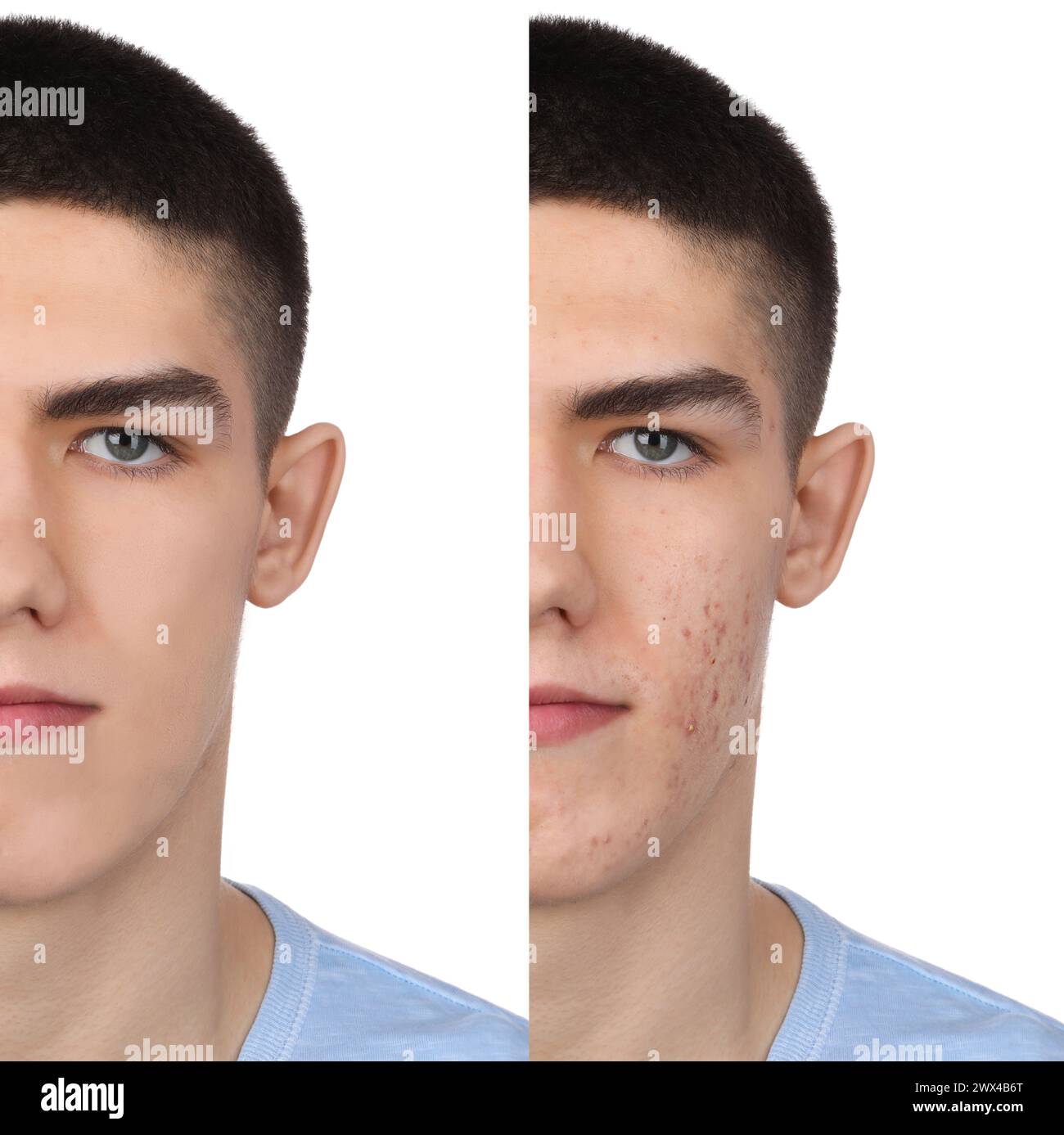 Acne problem. Young man before and after treatment on white background ...