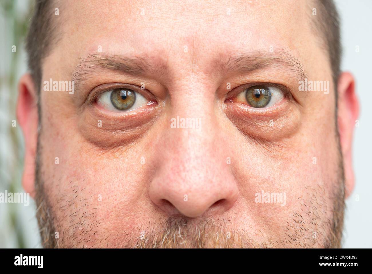 Close-up of a man's face: visible hemorrhage and redness of the eye, possible consequences of capillary rupture or infection. Stock Photo