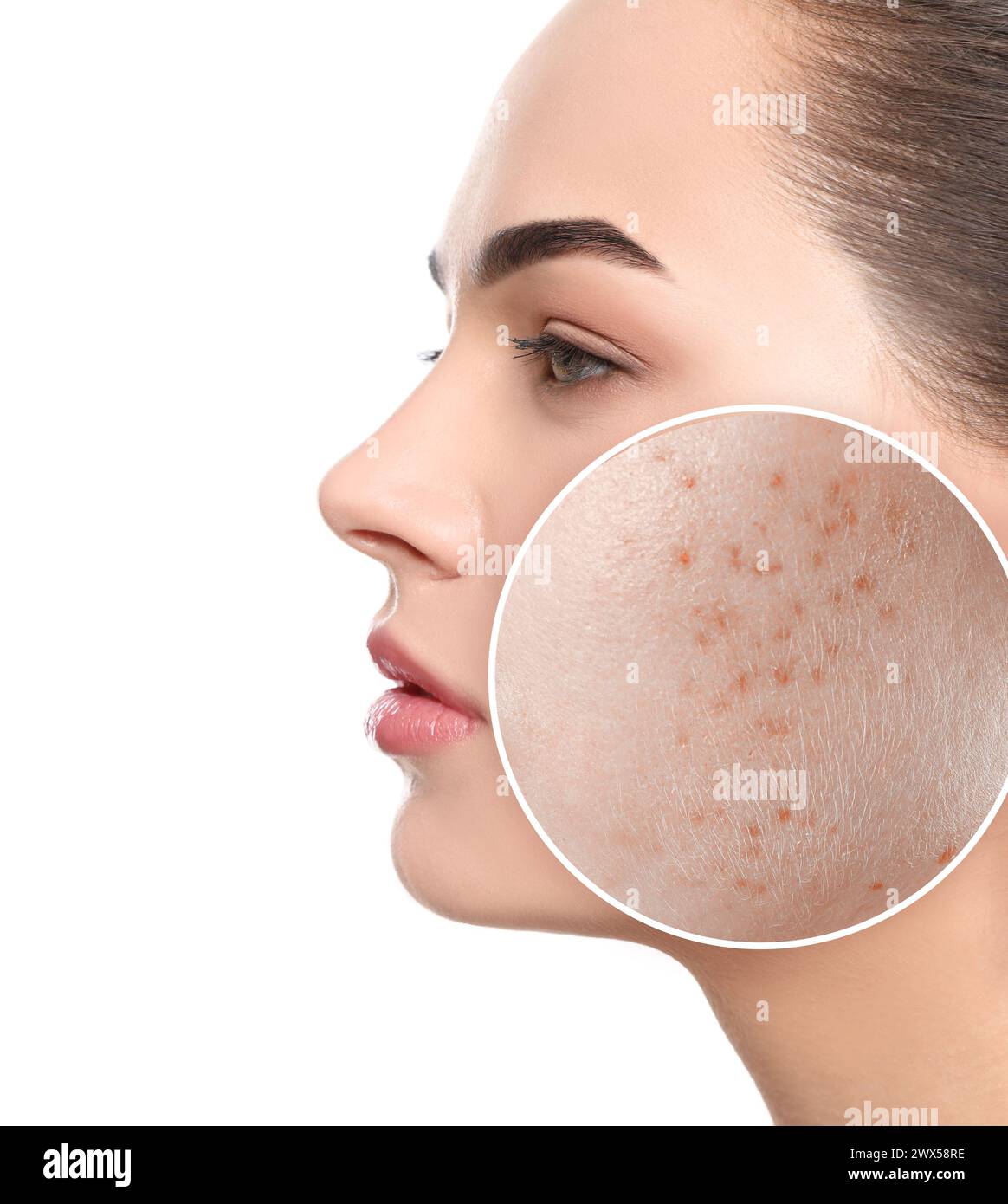 Woman with acne on her face on white background. Zoomed area showing ...