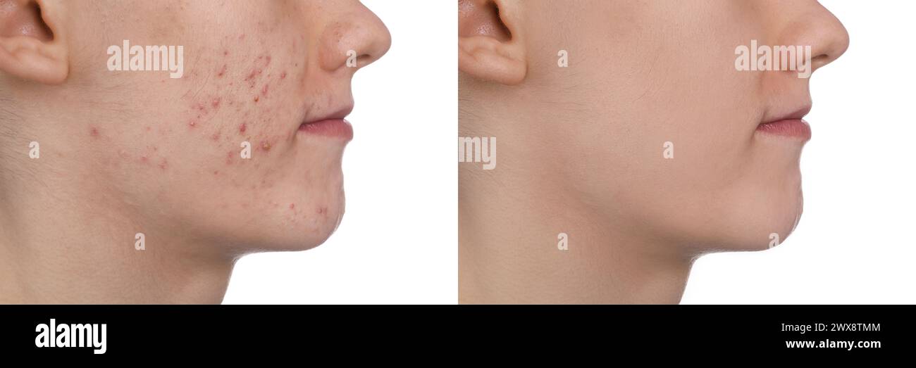 Acne problem. Young man before and after treatment on white background ...