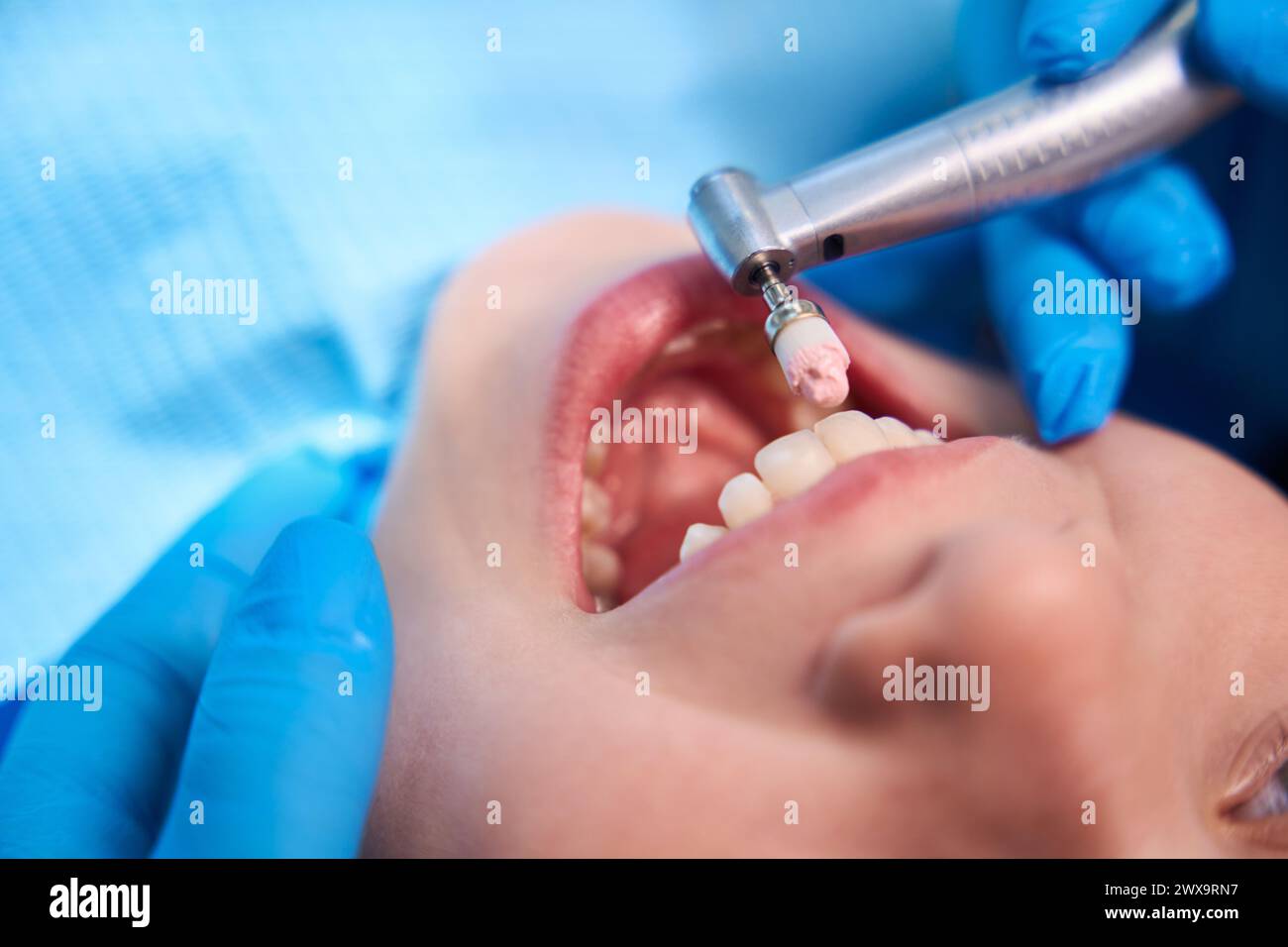 Procedure for polishing the teeth of a teenage girl Stock Photo