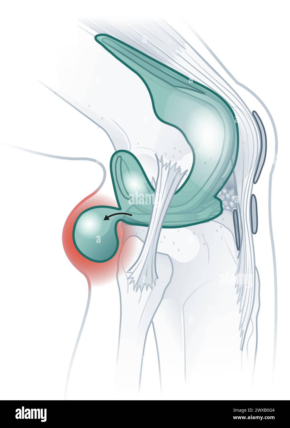 Baker's cyst fluidfilled swelling behind the knee due to underlying