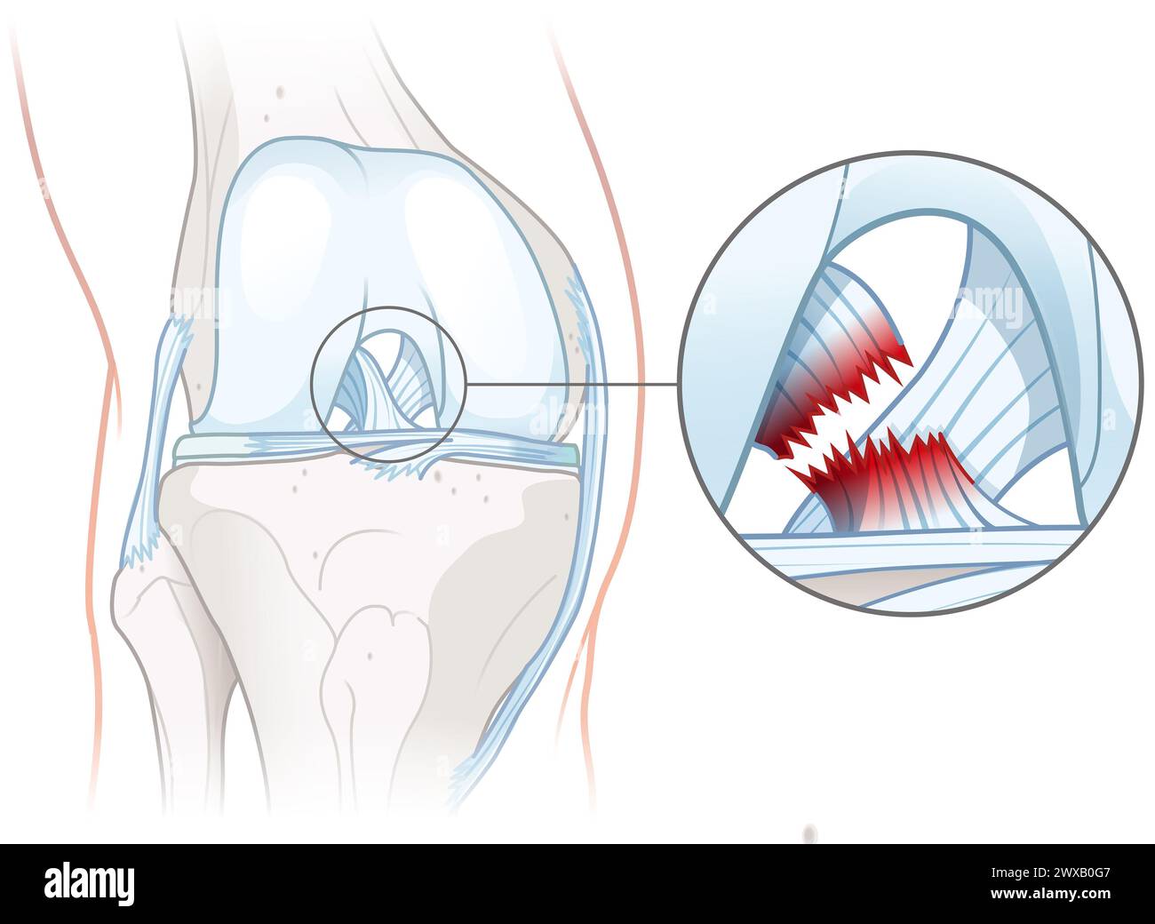 Anterior Cruciate Ligament Tear: Knee Injury Causing Instability, Pain ...