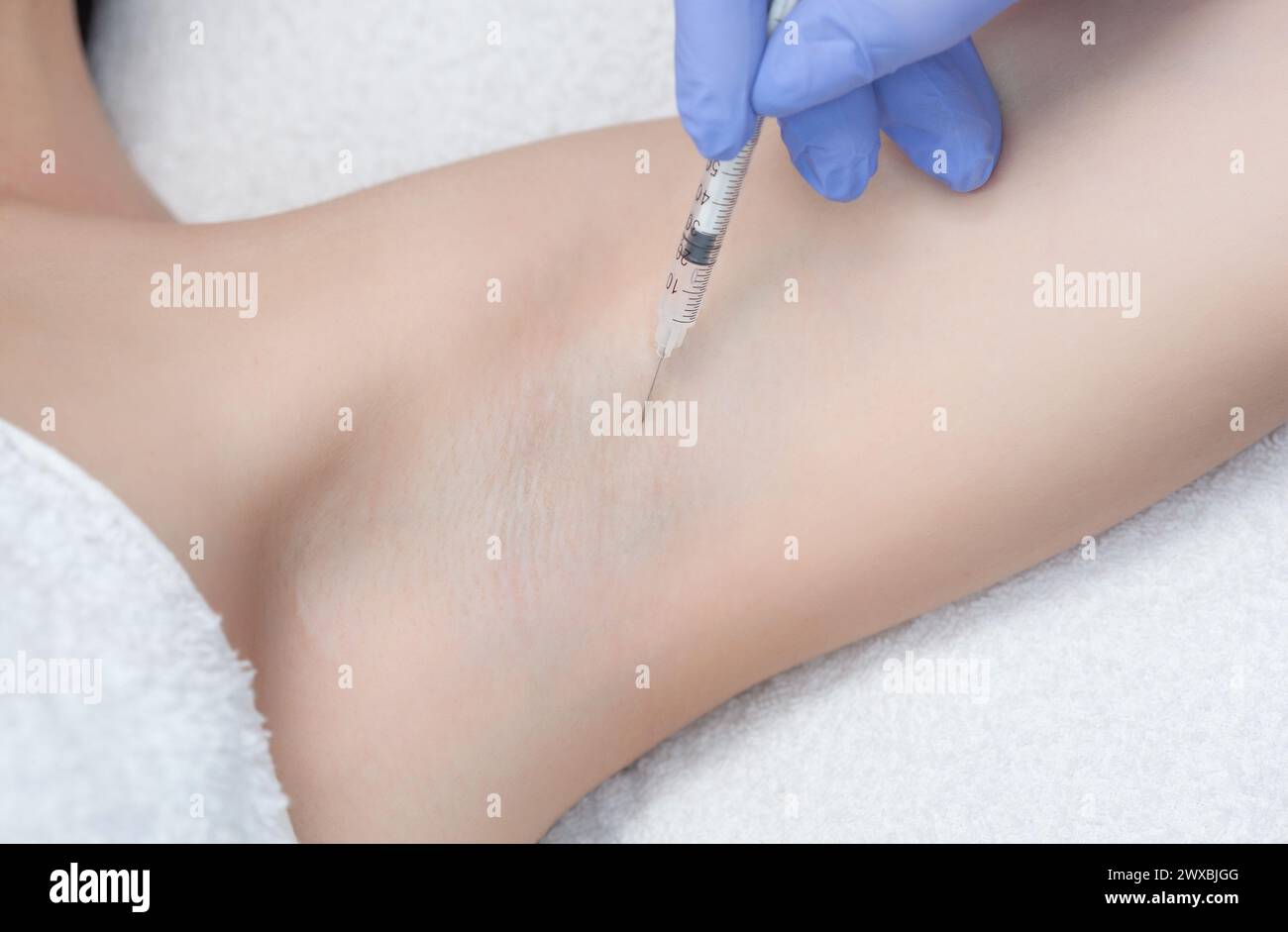 Hyperhydrosis Injection The doctor makes intramuscular injections of botulinum toxin in the ...