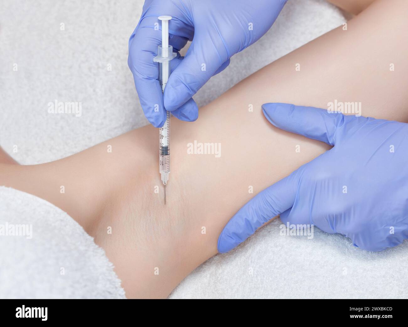 Hyperhydrosis Injection The doctor makes intramuscular injections of botulinum toxin in the ...