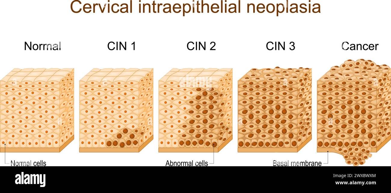 Cervical dysplasia. difference in covering epithelium affected of Cervical Intraepithelial Neoplasia. Cross section of epithelium. Close-up of a norma Stock Vector