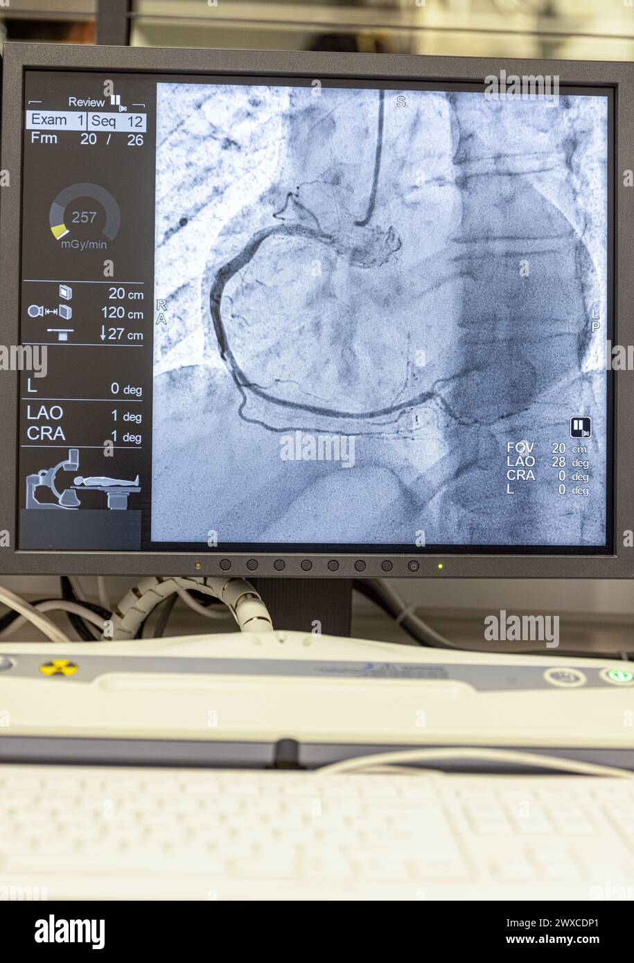 Angiogram sequence working clockwise using x-rays with a contrast agent injected from a tube inserted into the arteries (left & centre), to show the h Stock Photo