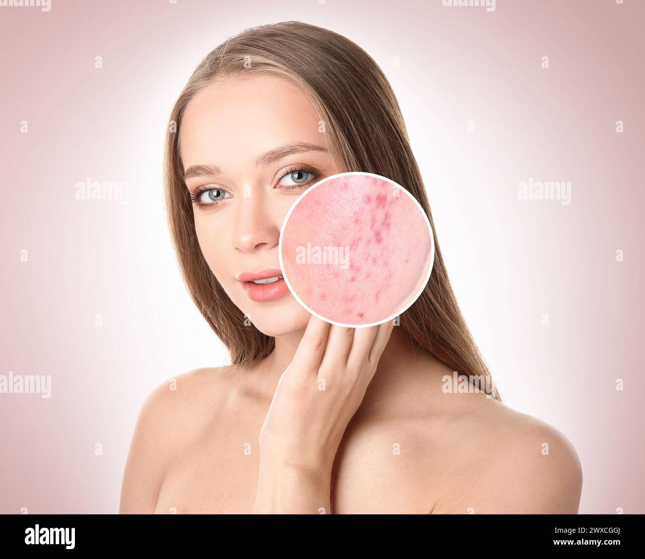 Woman with acne on her face on beige gradient background. Zoomed area ...