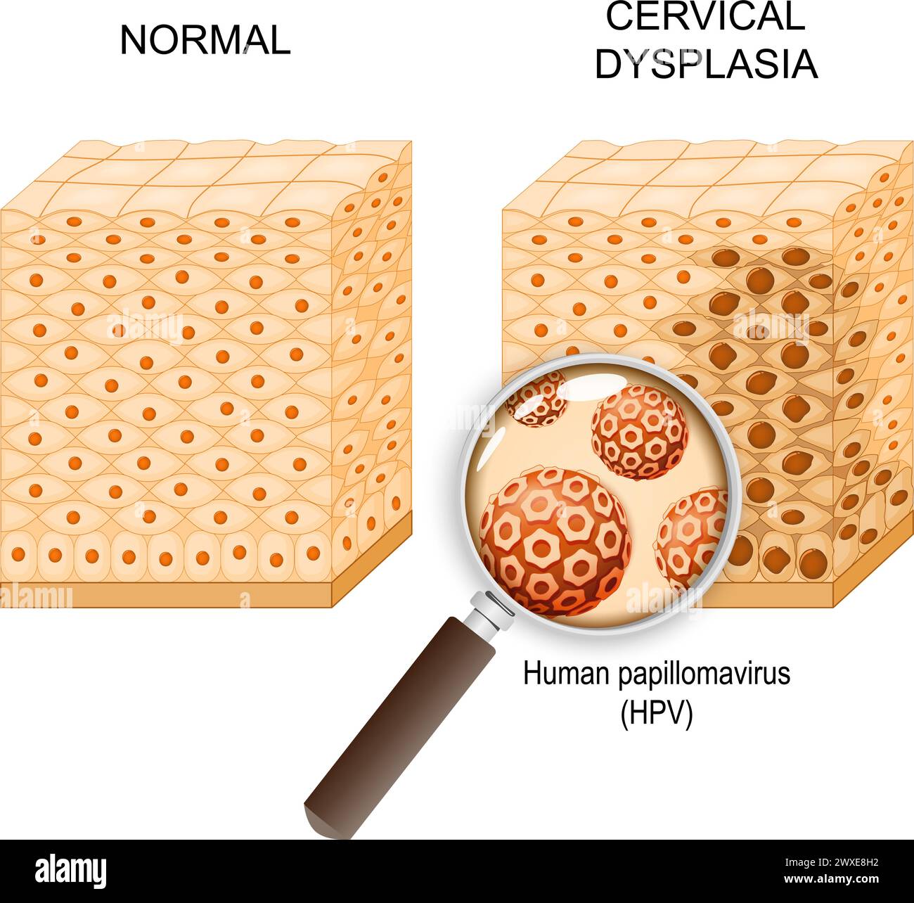 Cervical dysplasia. Cross section of a normal epithelium and Cervical Intraepithelial Neoplasia that caused of Human papillomavirus infection. Close-u Stock Vector