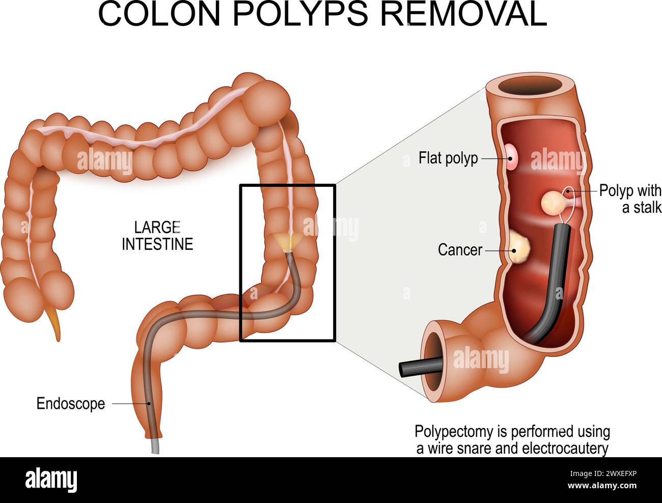 Colon polyps removal. Colonoscopy and Polypectomy. Colon cancer prevention. Human large intestine with Endoscope. Close-up of a cross section part of Stock Vector