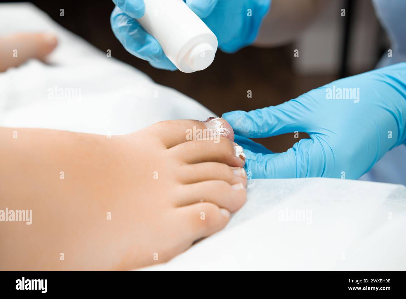 Application of antibiotic powder proves effective in combating toenail ailments caused by fungal
