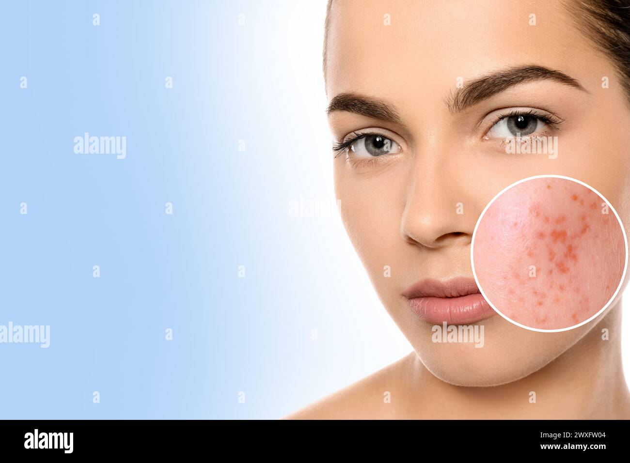 Woman with acne on her face on light blue gradient background, space ...