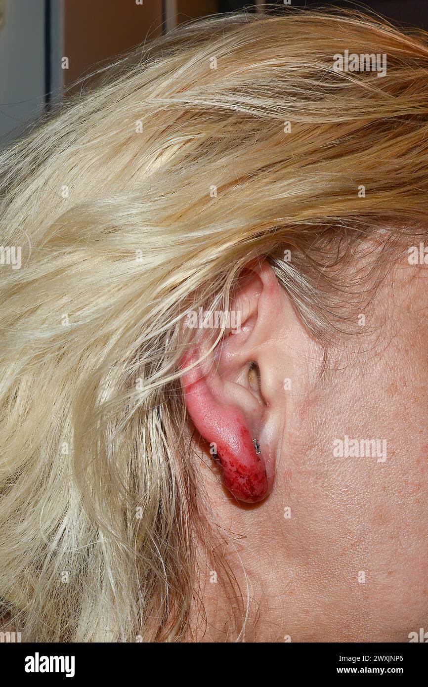 Inflamed and bloody earlobe after ear piercing Stock Photo