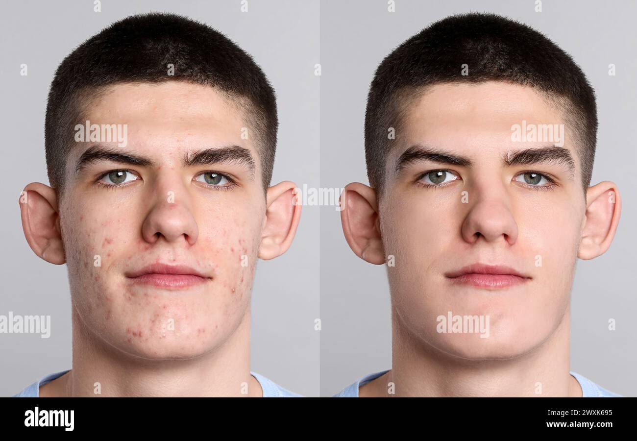 Acne problem. Young man before and after treatment on grey background ...