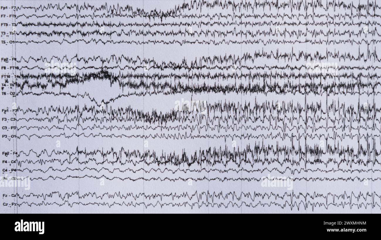 Imaging of ictal EEG recording in epilepsy patient during monitoring. Stock Photo