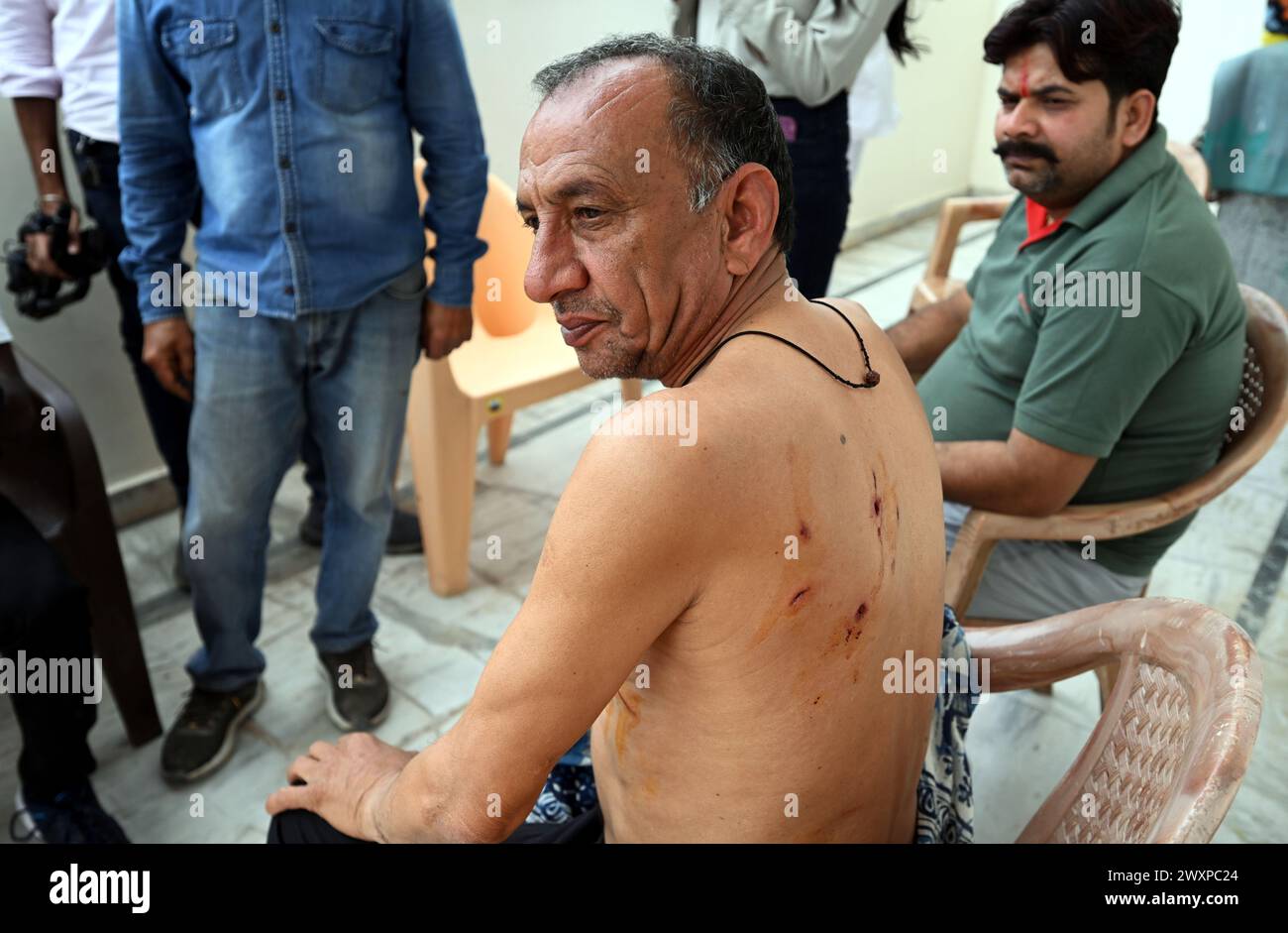 NEW DELHI, INDIA - APRIL 1: Injured Satish after Leopard attacked at Jagatpur Village near Wazirabad on April 1, 2024 in New Delhi, India. At least five people were injured when a leopard wandered into a village in north Delhi’s Wazirabad on Monday morning, causing panic among the locals. Officials said the leopard was rescued afterwards. (Photo by Arvind Yadav/Hindustan Times/Sipa USA ) Stock Photo