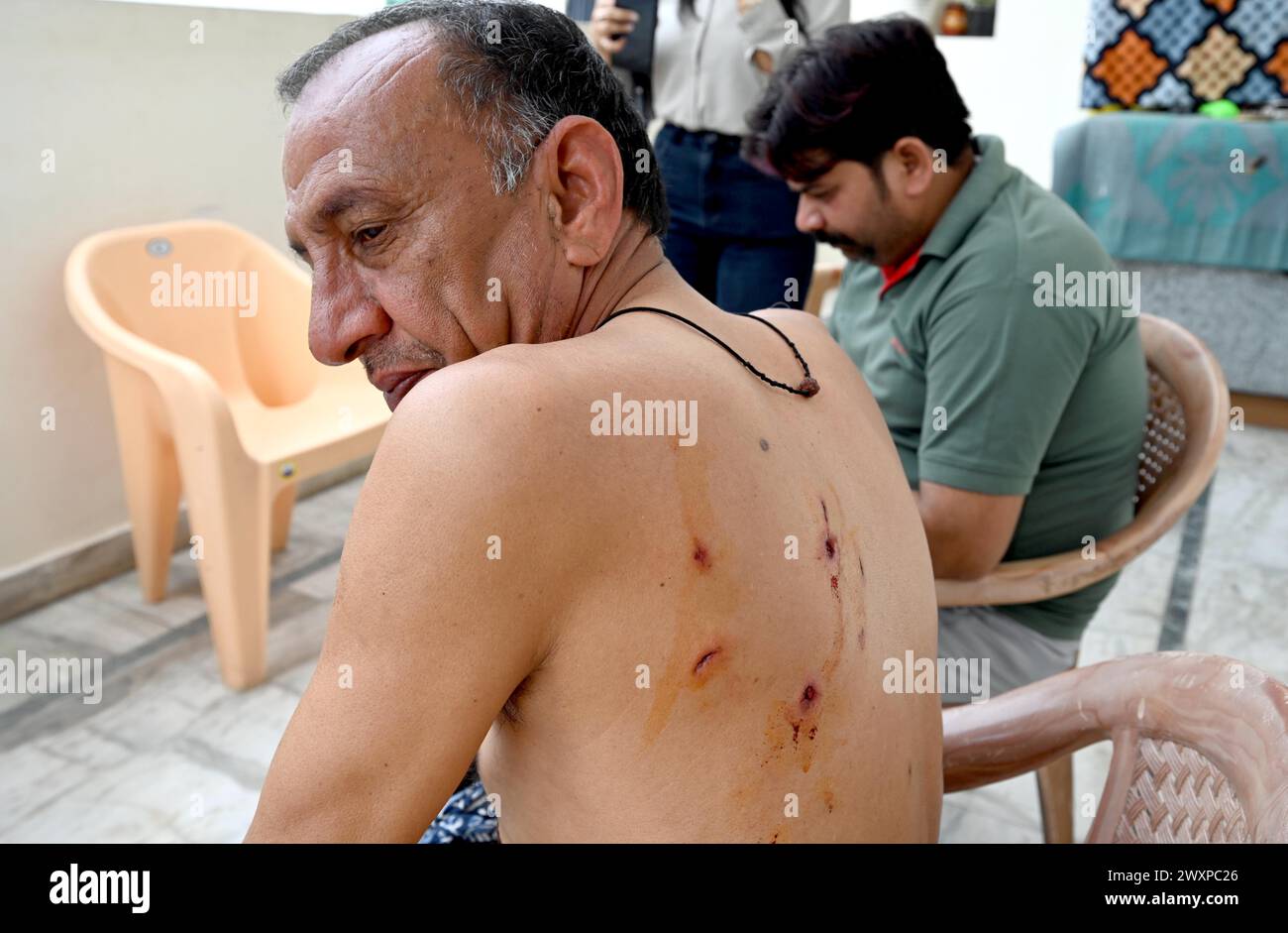 NEW DELHI, INDIA - APRIL 1: Injured Satish after Leopard attacked at Jagatpur Village near Wazirabad on April 1, 2024 in New Delhi, India. At least five people were injured when a leopard wandered into a village in north Delhi’s Wazirabad on Monday morning, causing panic among the locals. Officials said the leopard was rescued afterwards. (Photo by Arvind Yadav/Hindustan Times/Sipa USA ) Stock Photo