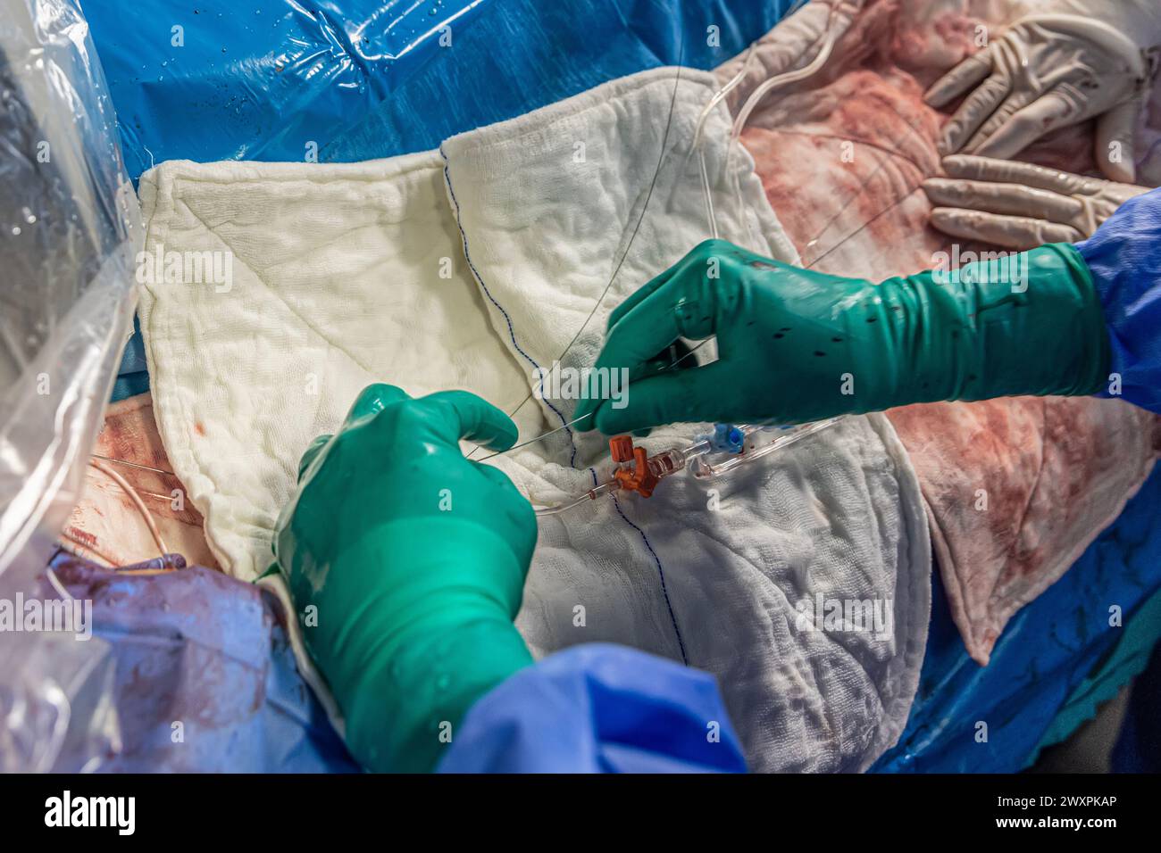 Heart stent placement process in operating room. Heart doctor inserting ...