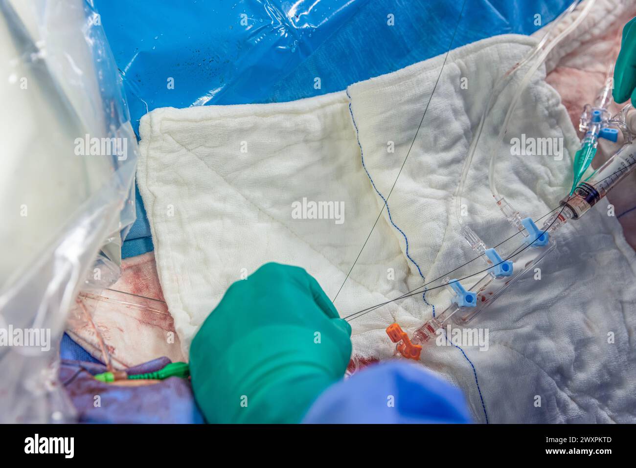 Heart stent placement process in operating room. Heart doctor inserting