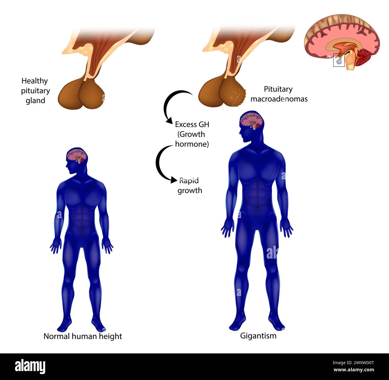 Gigantism also known as giantism. Adenoma, a tumor of the pituitary gland. Excess GH Stock Vector