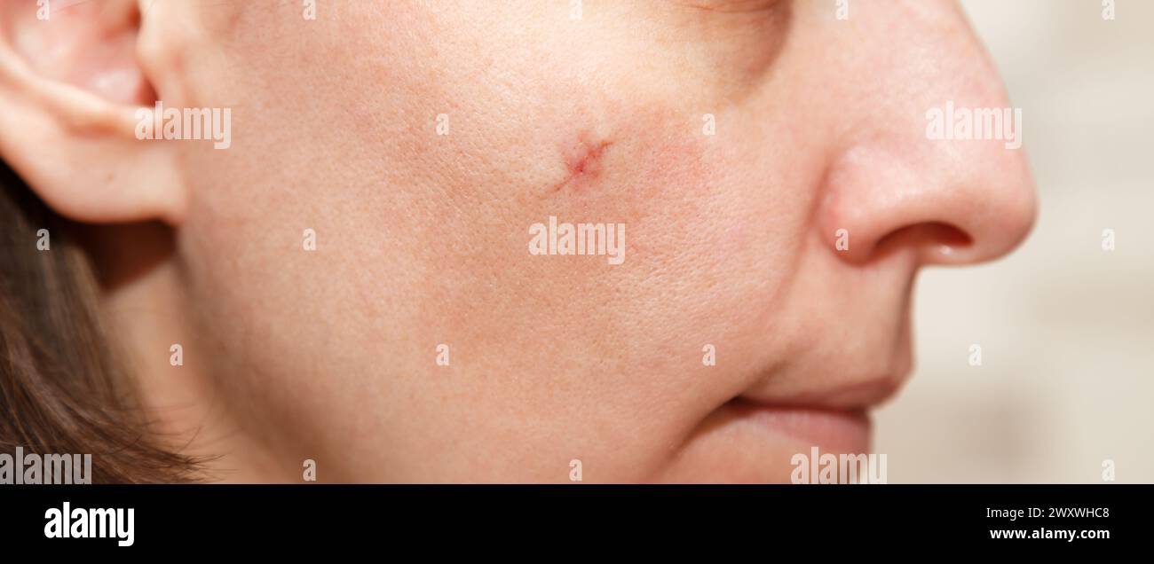 Real scar on the young woman face, scar on the cheek after a mole removal surgery. Scar after plastic surgery Stock Photo