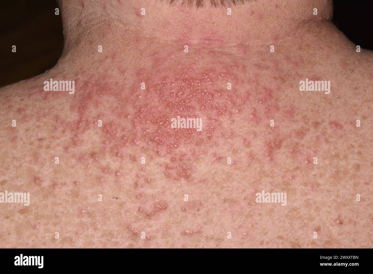 Acute eczematous rash on back of the neck of a 51 year old male patient ...