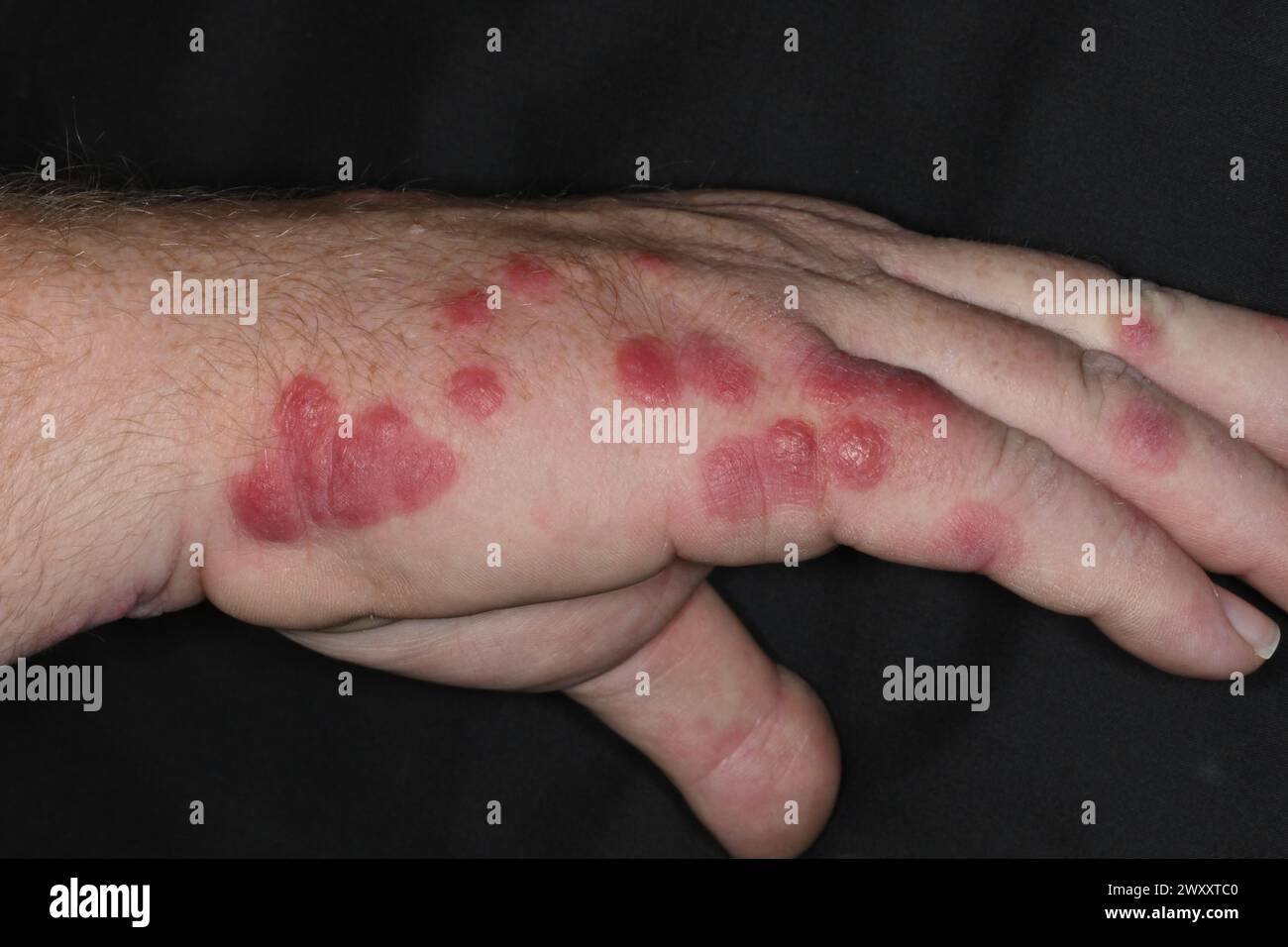 Allergic reaction to insect bites on the hand of a 45 year old female ...
