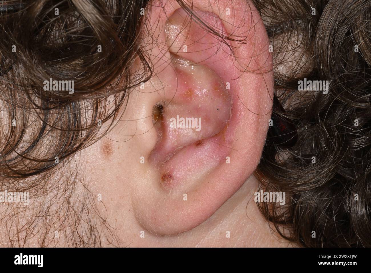 Blisters Inside Ear _ Bullous Myringitis: Symptoms, Causes, Treatment ...