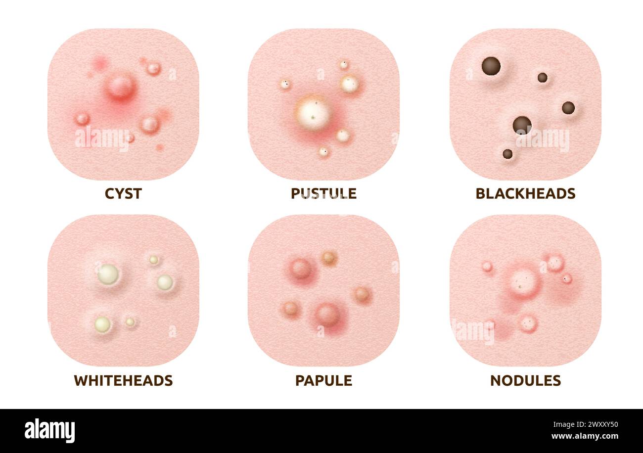 Body skin acne type blackheads, whiteheads, papule, pustule, cyst and nodules. Realistic 3d vector skin disease caused by excess oil production, bacteria, and inflammation, hormonal changes or sweat Stock Vector