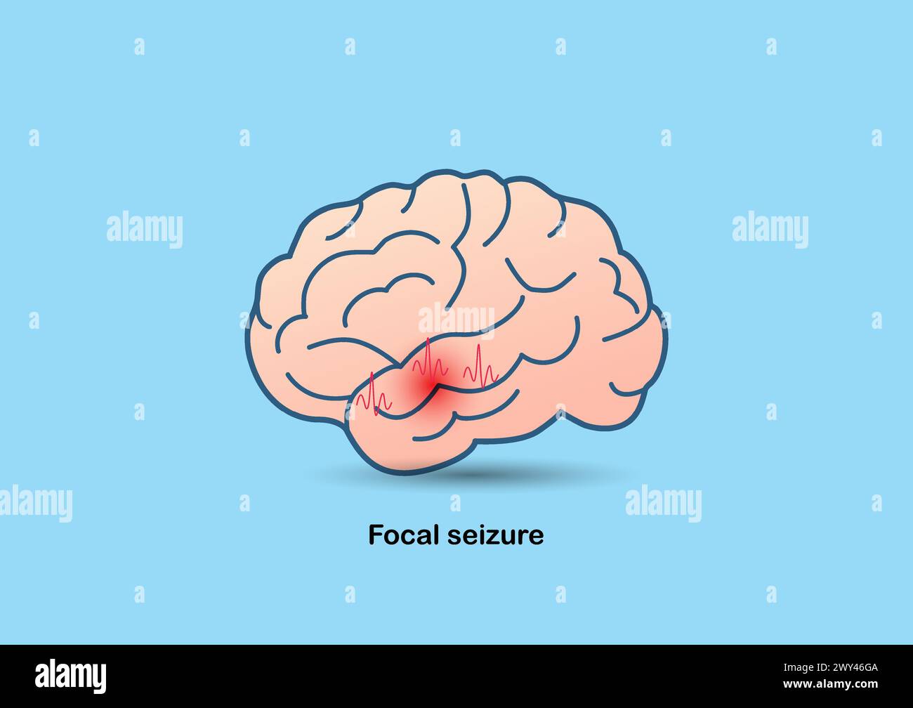 Illustration of brain and abnormal brain waves symbolizing focal epilepsy. Stock Vector
