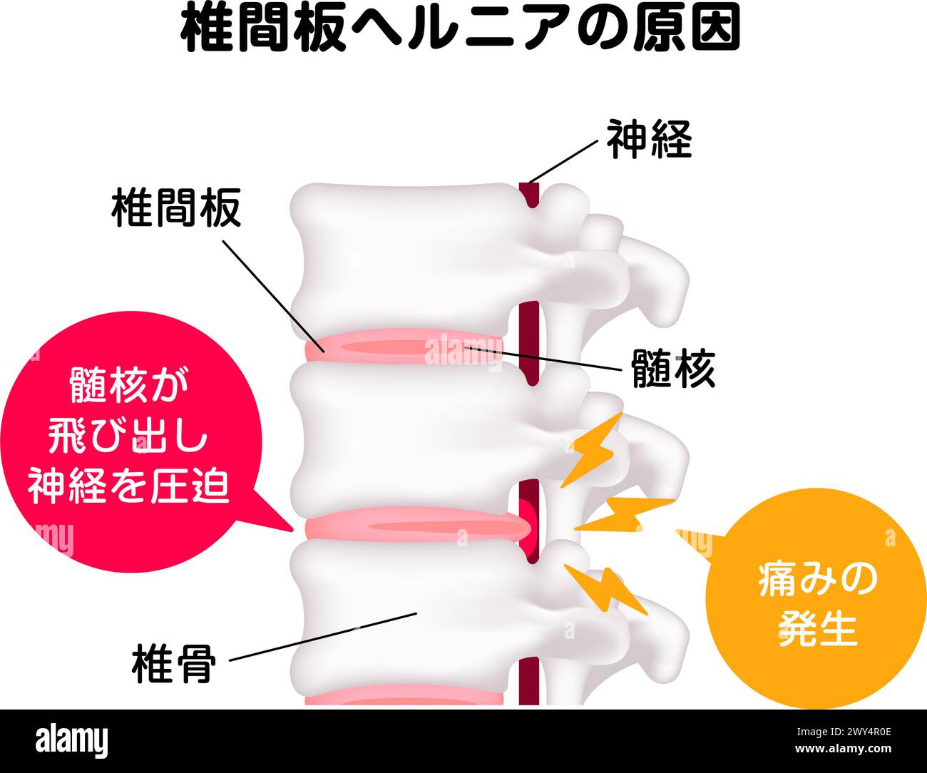 Spinal disc herniation vector illustration Stock Vector