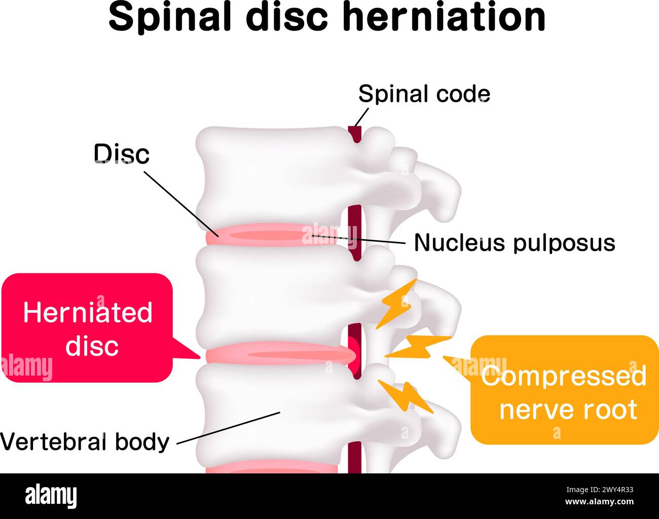 Spinal disc herniation vector illustration Stock Vector