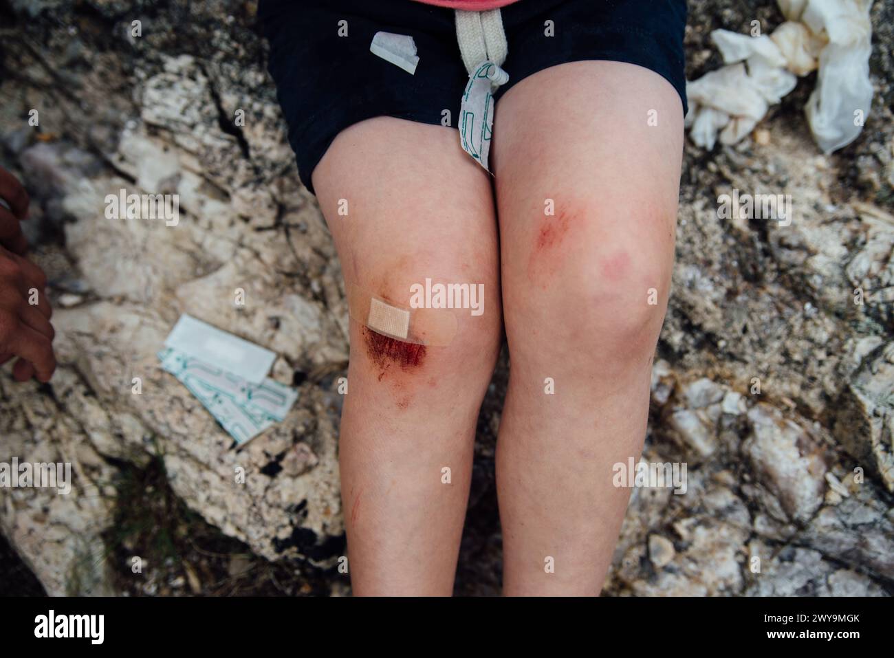 Close up of child's skinned knee with bandages and wrappers. Stock Photo