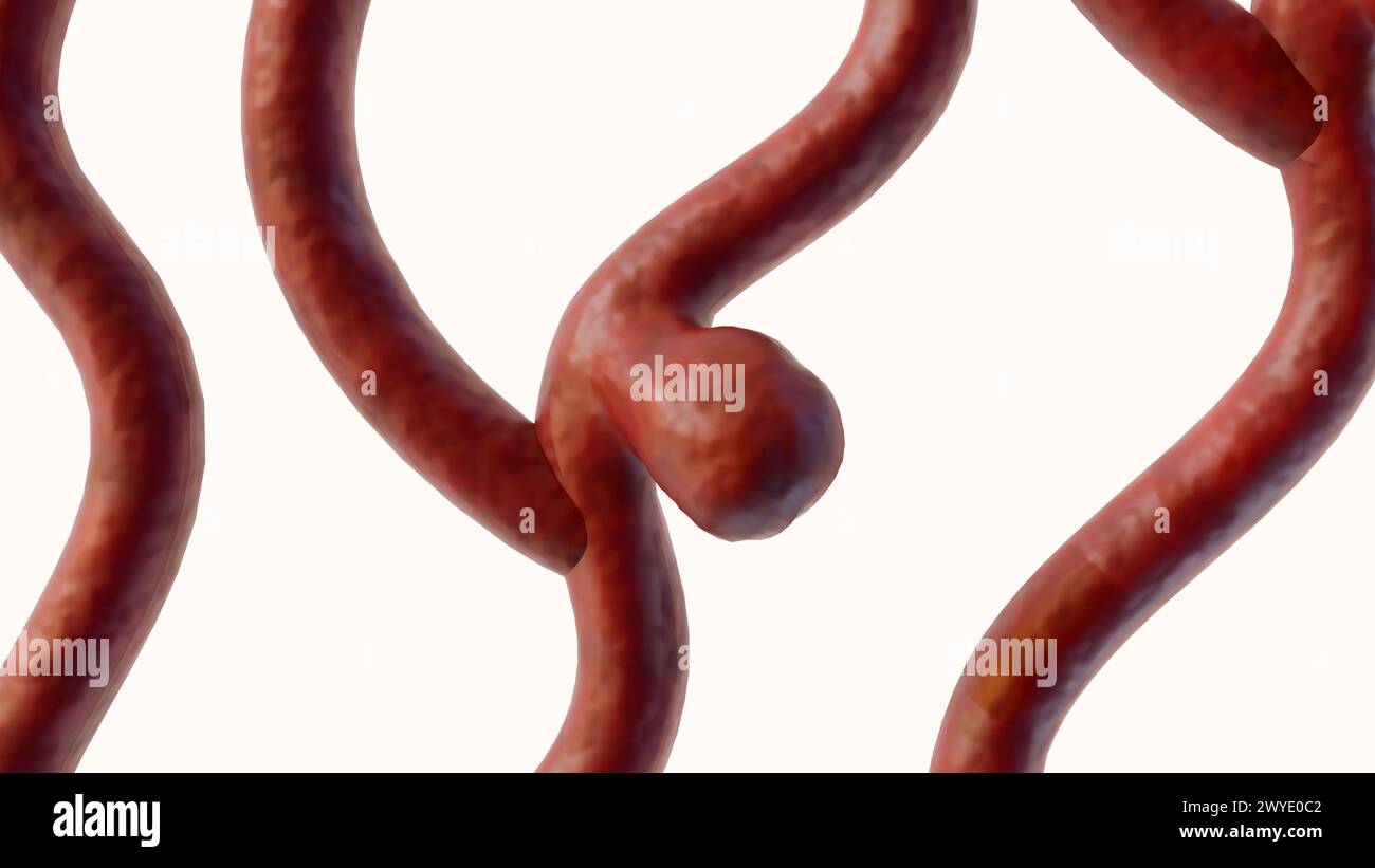 3d rendering of a saccular aneurysm, also known as a berry aneurysm, is a bulge that forms on the wall of a blood vessel in the brain Stock Photo