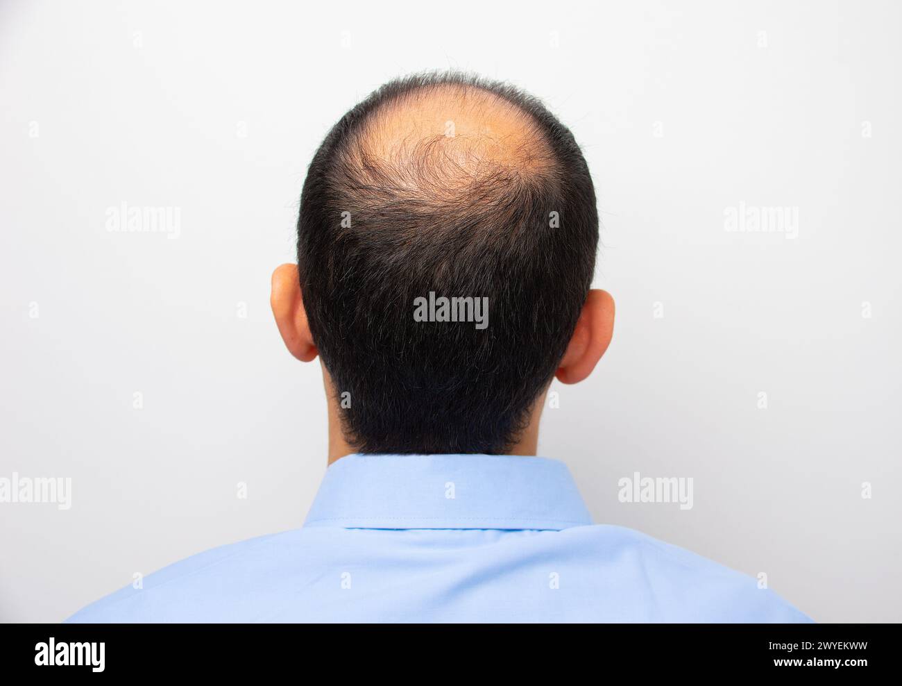 Rear view of a male head with thinning hair or alopecia Stock Photo