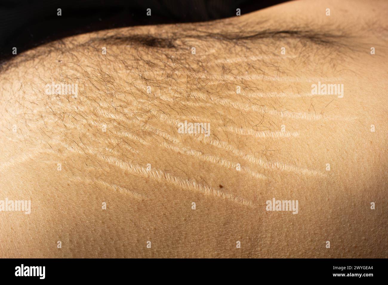 Explore the impact of weight changes, including obesity and muscle gain