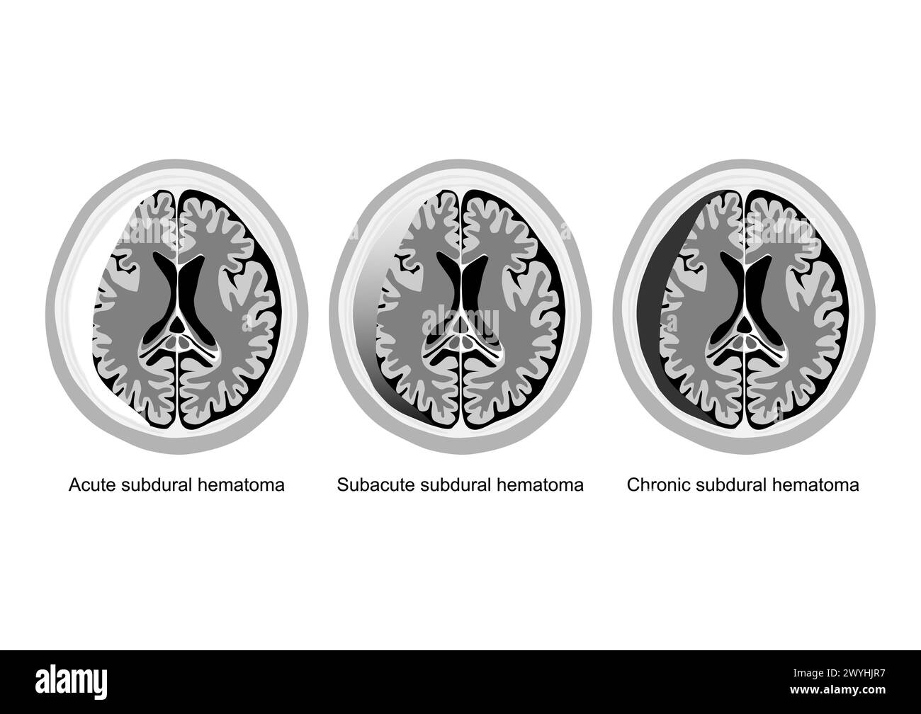 Three medical illustrations showing acute, subacute, and chronic subdural hematoma stages in brain injury. Stock Vector