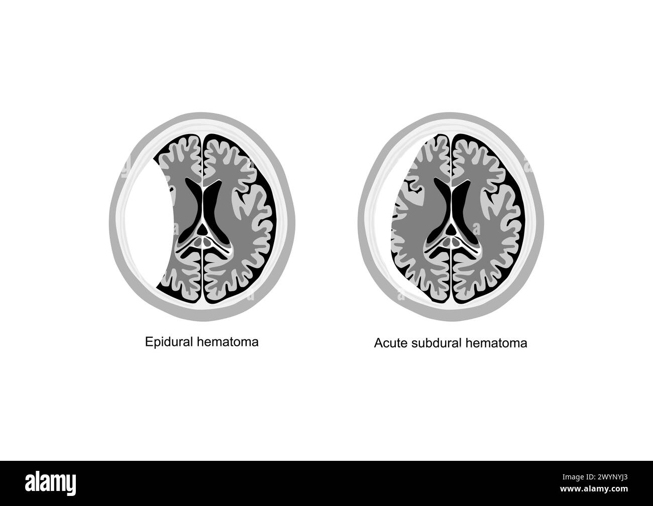 Comparative medical illustration of epidural and acute subdural hematoma in the human brain. Stock Vector