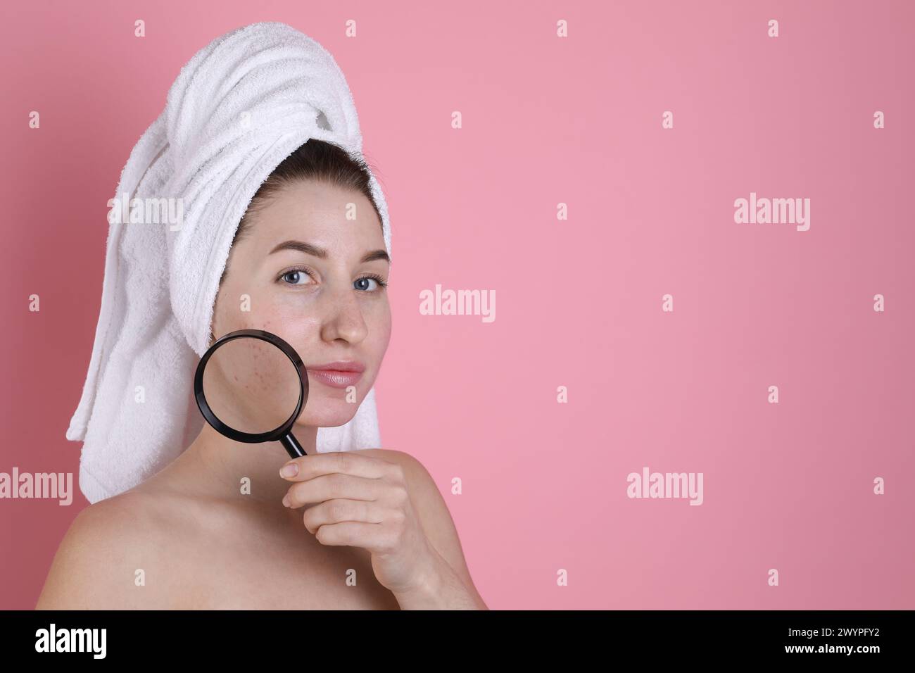 Young woman with acne problem holding magnifying glass near her skin on ...